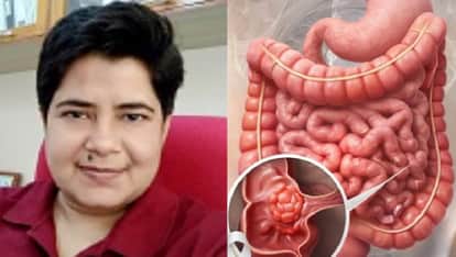 Kanpur DKC1 Protein Fuels Intestinal Cancer and Renders Treatment Ineffective Bushra Ateeq Decodes Mechanism
