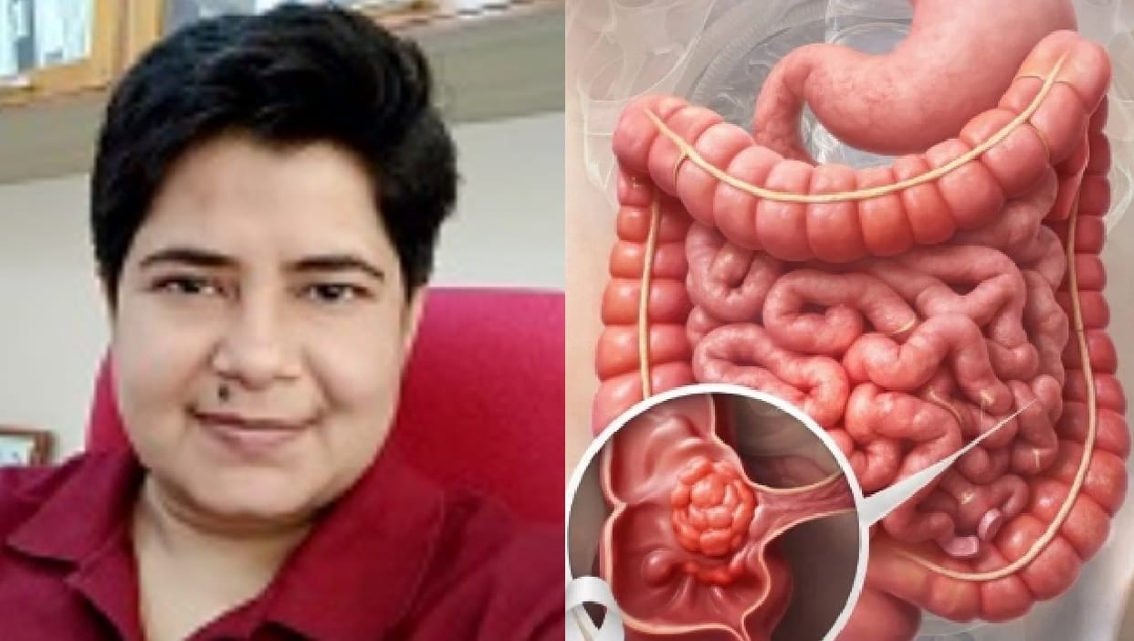 Kanpur DKC1 Protein Fuels Intestinal Cancer and Renders Treatment Ineffective Bushra Ateeq Decodes Mechanism