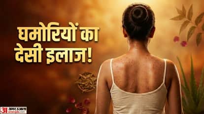 Skin Care Tips For Heat Rash Home Remedies Ghamoriya ka ilaj