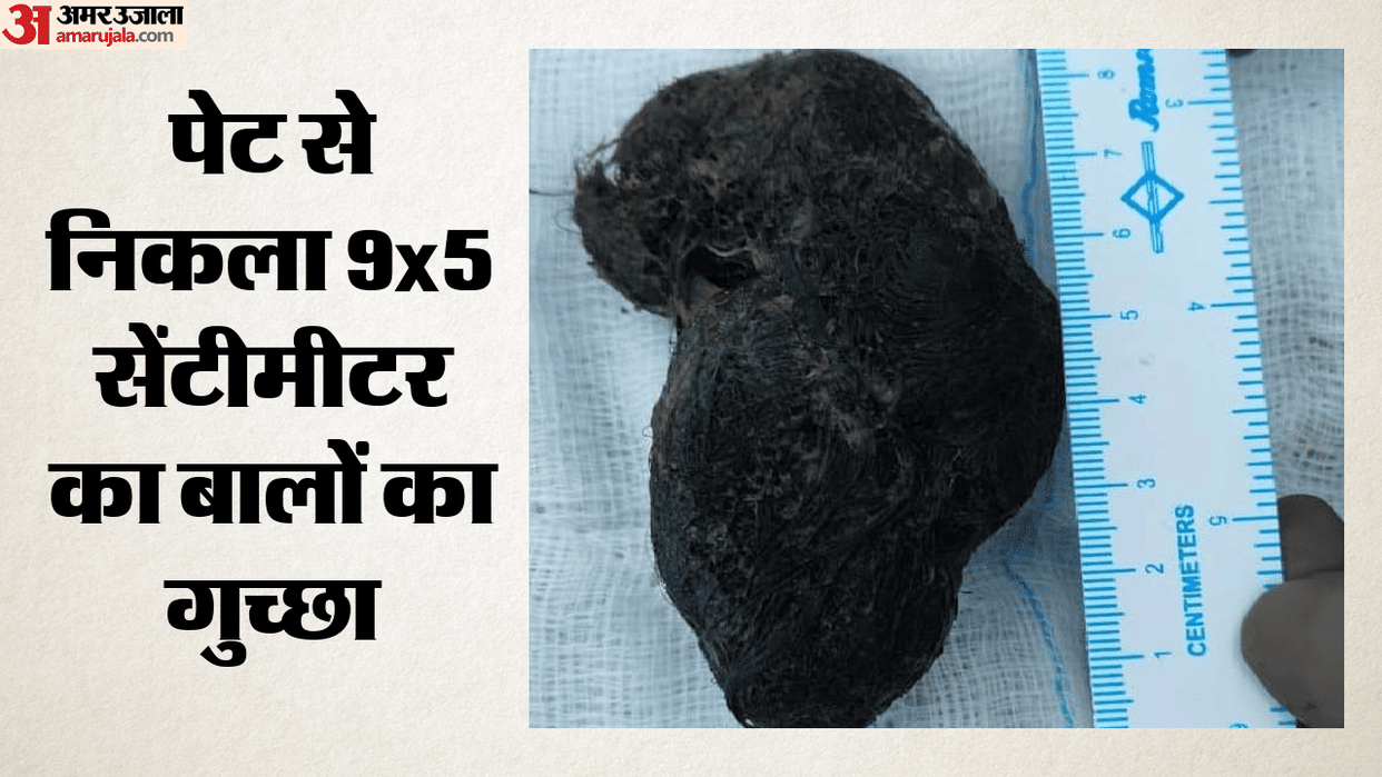Ball of hair removed from young man's stomach