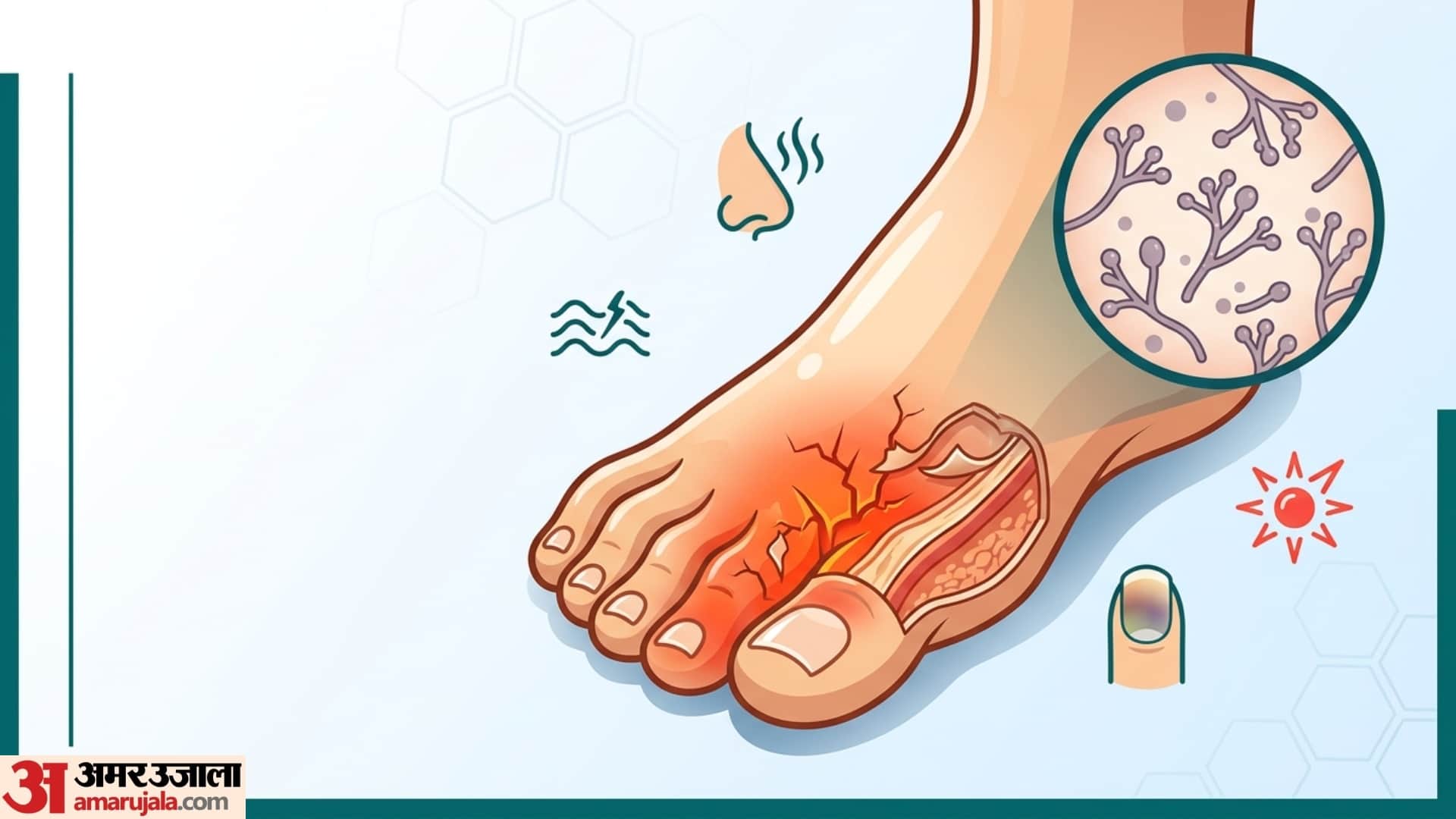 best remedy for fungal infection in foot fingers pairo se badbu aaye to kya kare
