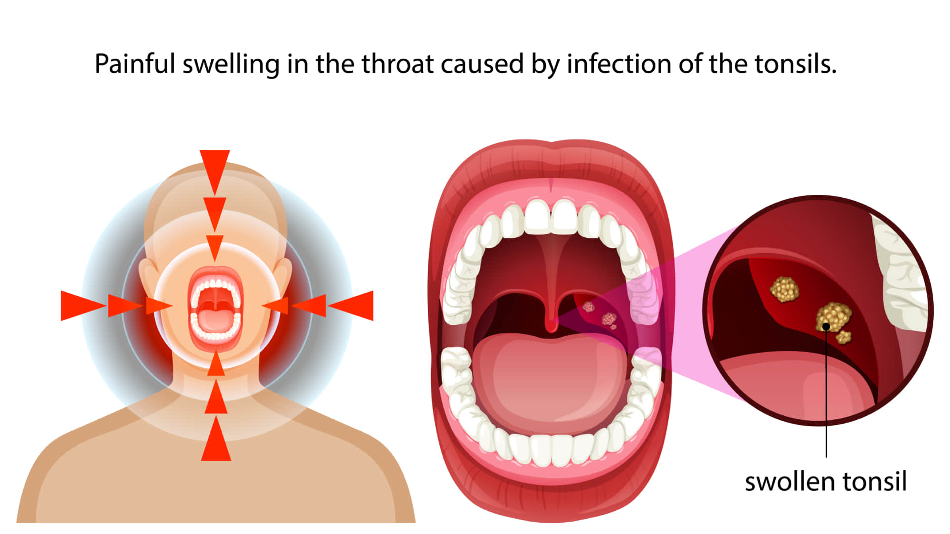 tonsil stones causes symptoms and treatment know tonsil stones kyu hote hai