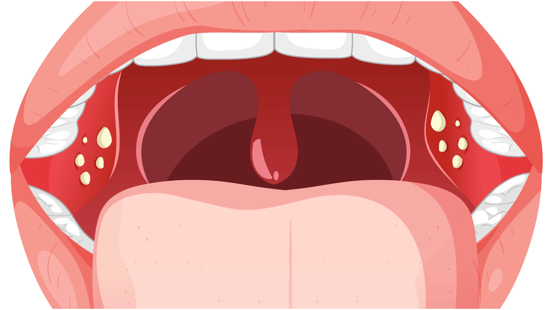 tonsil stones causes symptoms and treatment know tonsil stones kyu hote hai