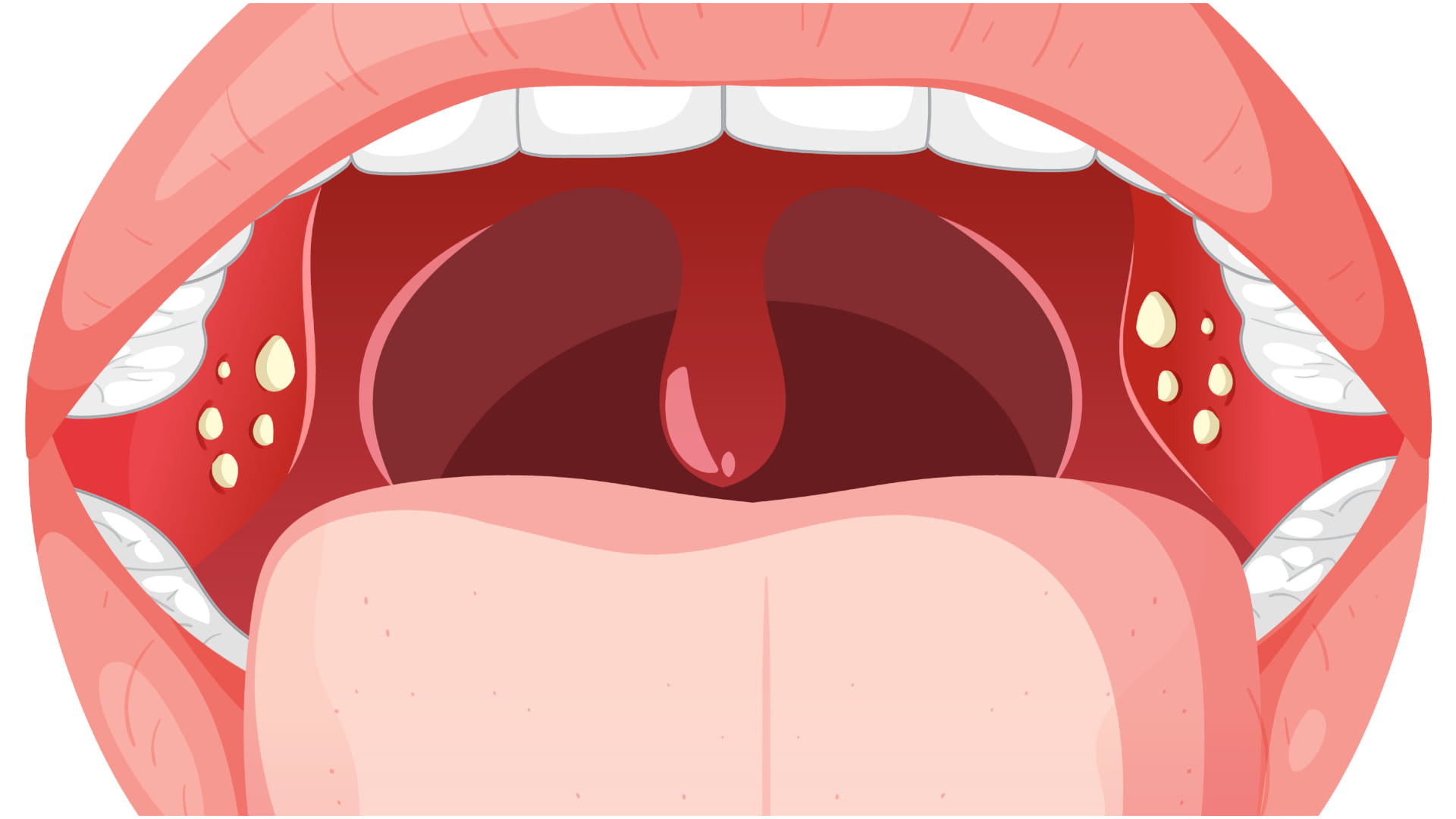 tonsil stones causes symptoms and treatment know tonsil stones kyu hote hai