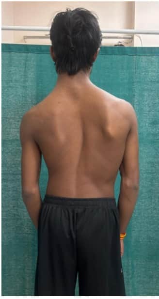 Curved spine no longer a problem: AIIMS treats patient using robotic technology; 16-year-old's curved spine st
