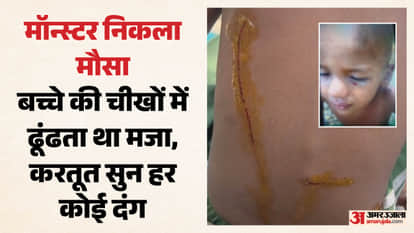 Uncle-in-law burns two-and-a-half-year-old child face with bidi and ten deep wounds on his body