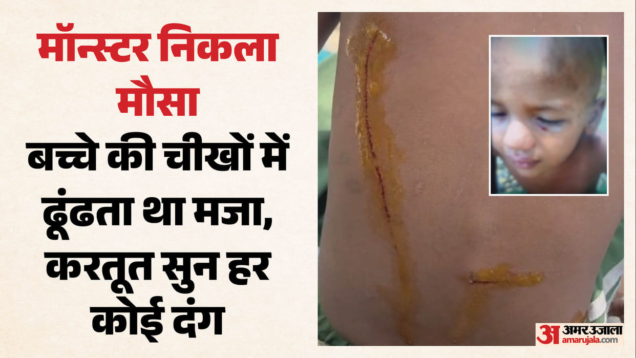 Uncle-in-law burns two-and-a-half-year-old child face with bidi and ten deep wounds on his body