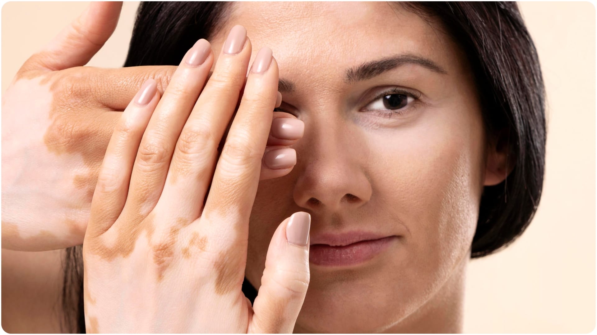 why is Vitiligo know its causes and risk factors skin par white spot kyu hota hai