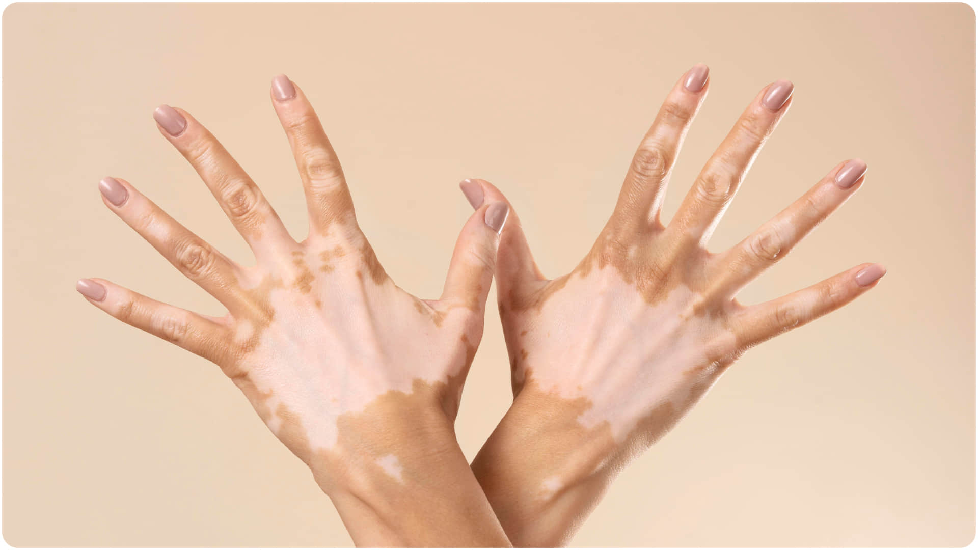 why is Vitiligo know its causes and risk factors skin par white spot kyu hota hai