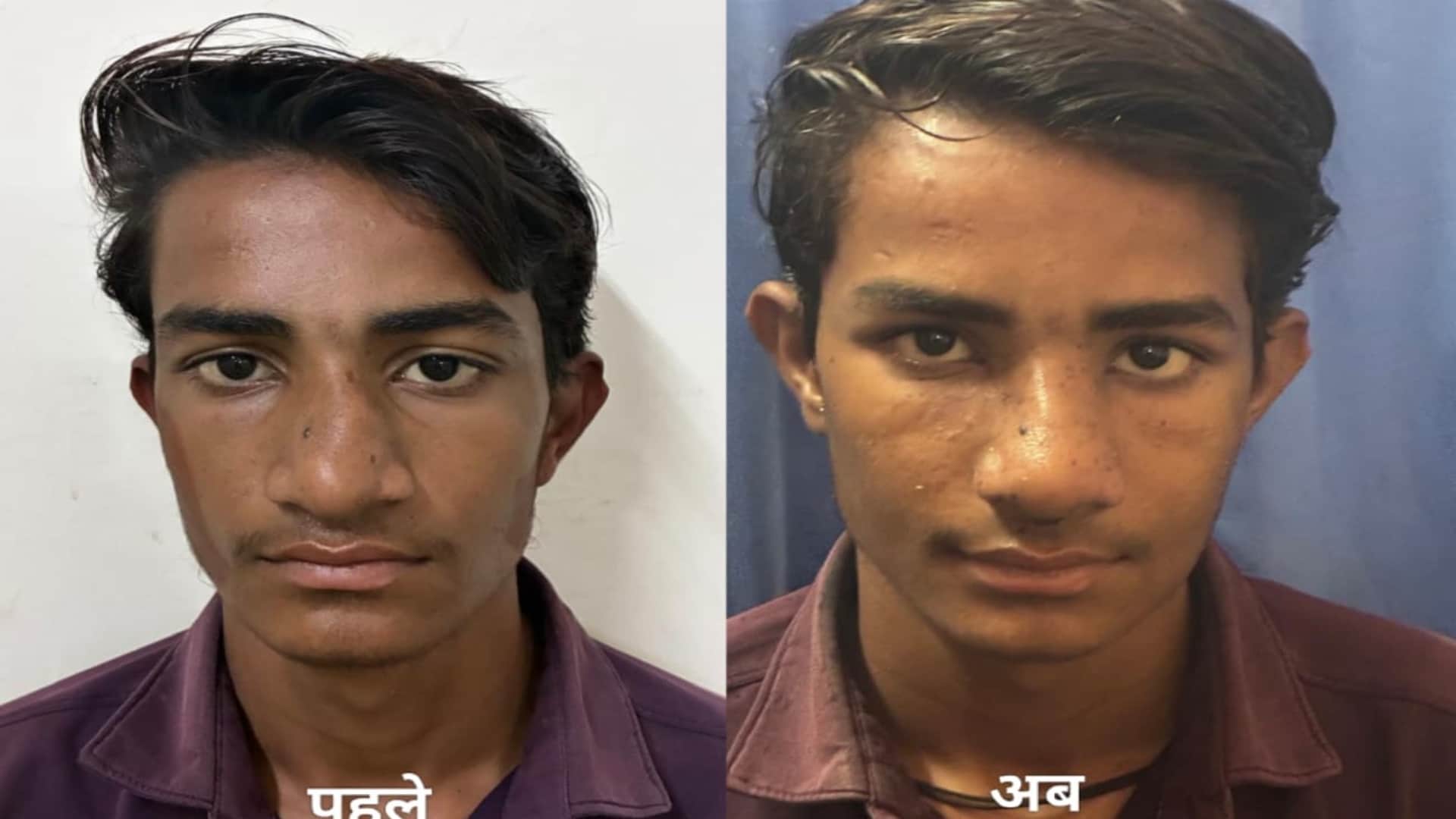 नाक की जटिल सर्जरी के बाद मरीज के फोटो