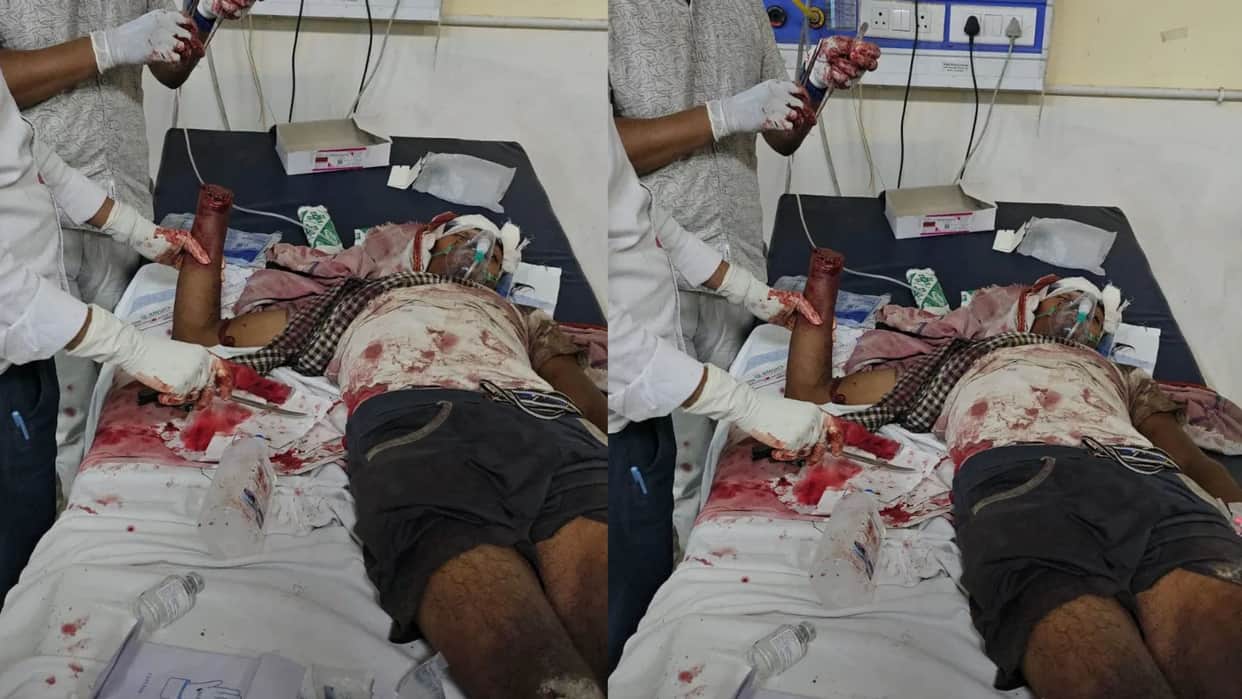 Darbhanga Bomb Blast Two Youth Seriously Injured in Broad Daylight Explosion; Panic Grips Area