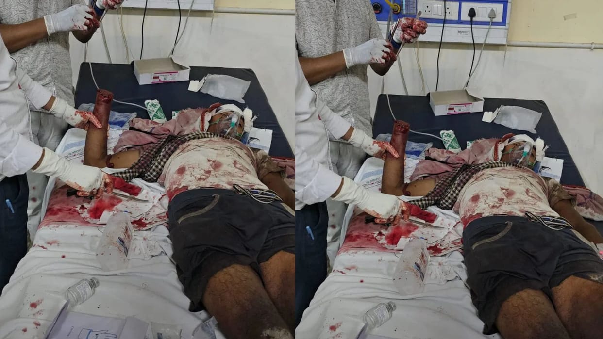 Darbhanga Bomb Blast Two Youth Seriously Injured in Broad Daylight Explosion; Panic Grips Area