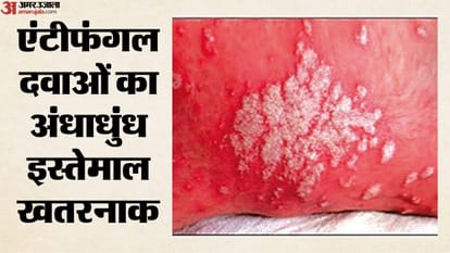 क्यों बढ़ा फंगल इंफेक्शन का खतरा?