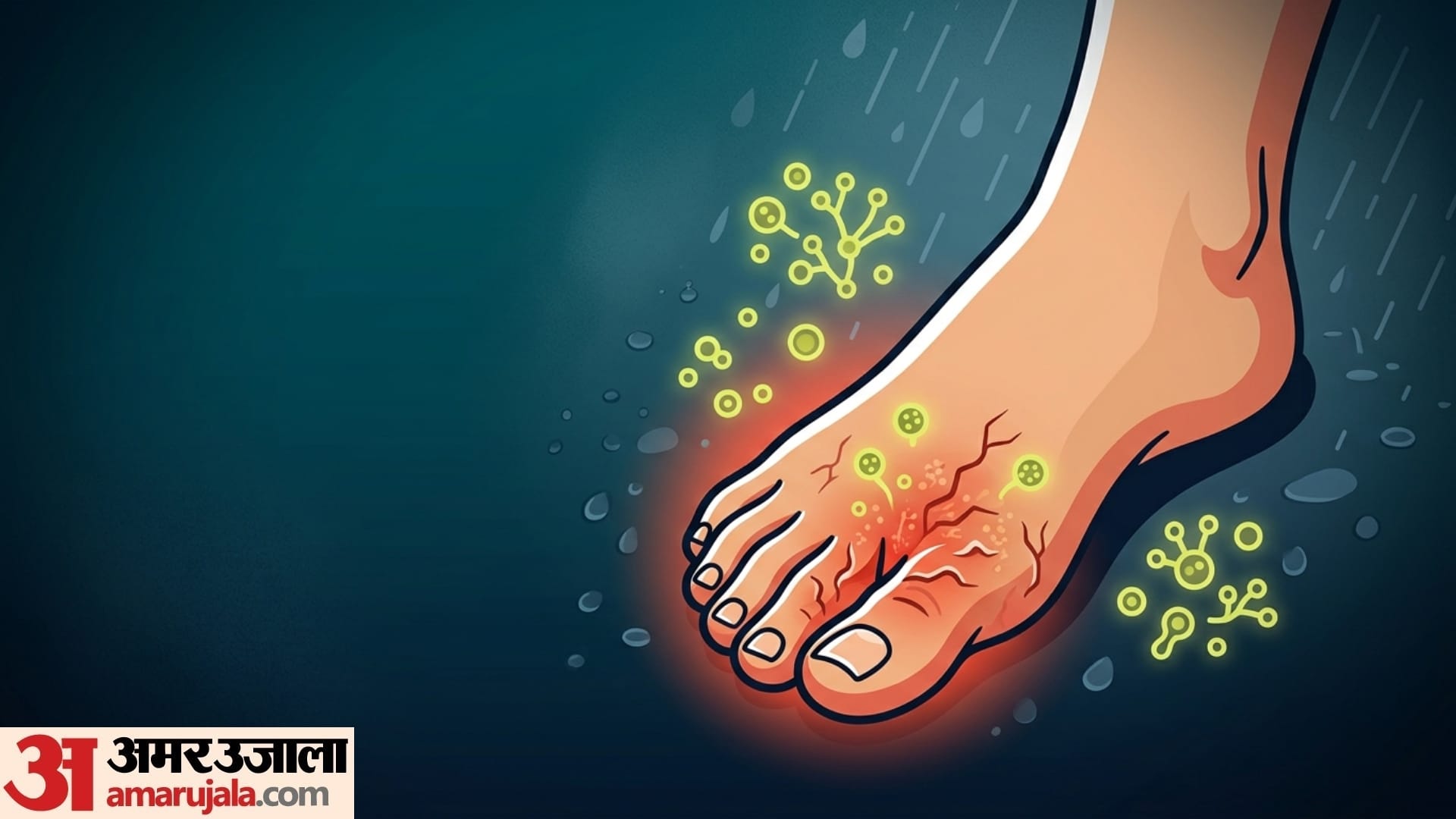 Monsoon foot Care 5 symptoms of yeast infection in foot in monsoon season
