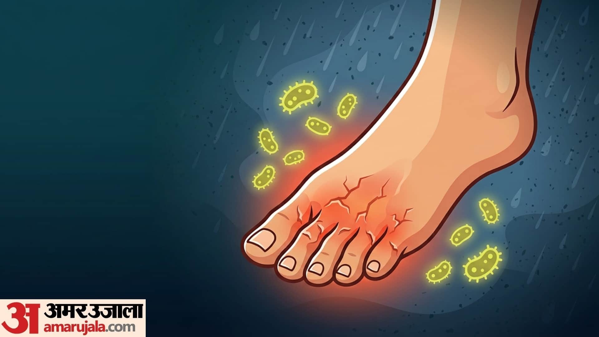Monsoon foot Care 5 symptoms of yeast infection in foot in monsoon season