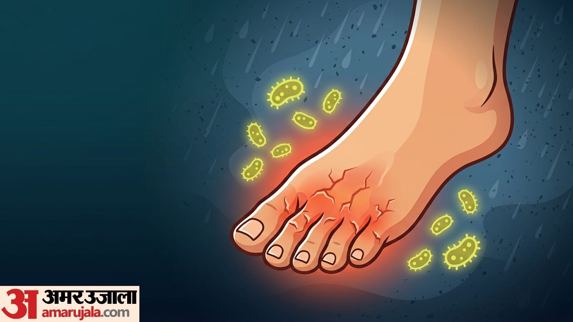 Monsoon foot Care 5 symptoms of yeast infection in foot in monsoon season