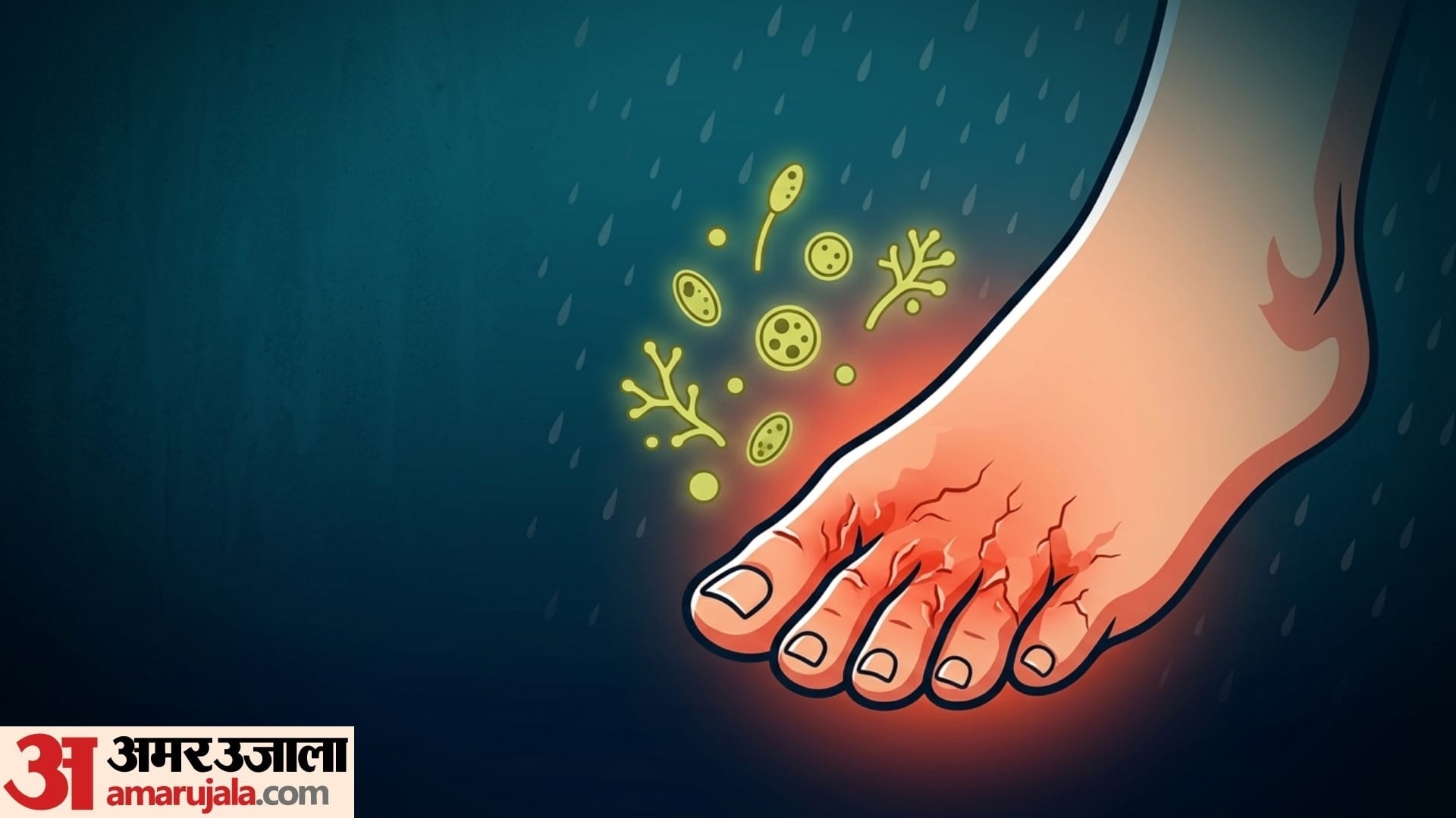 Monsoon foot Care 5 symptoms of yeast infection in foot in monsoon season