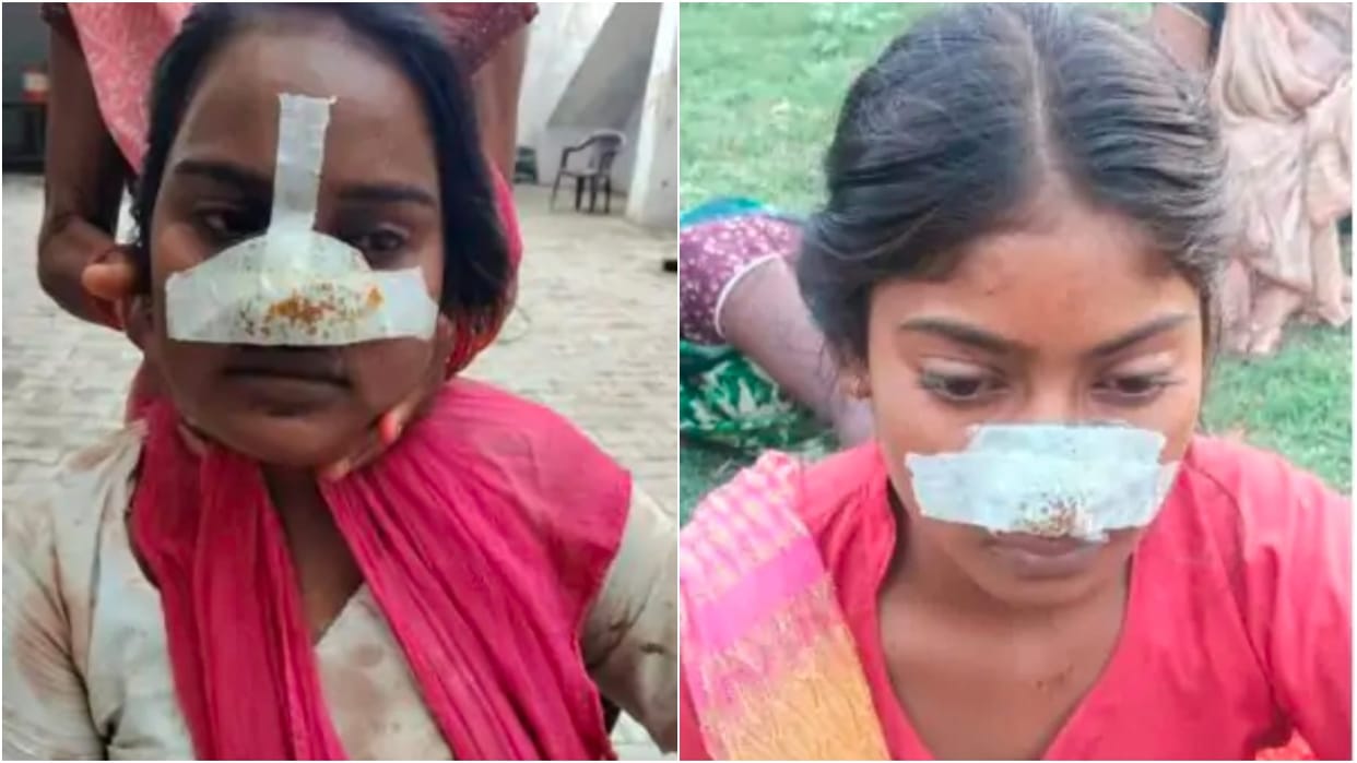 Man cuts off wife nose over her insistence on visiting her parents home in Lakhimpur kheri