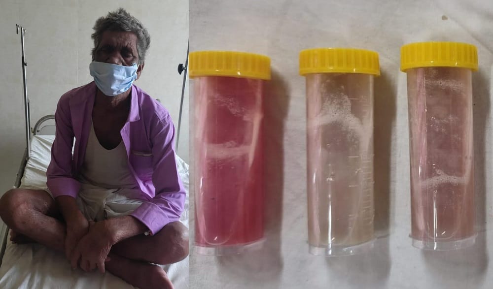 Kanpur 150 ml of pus removed via bronchoscopy severe pneumonia patient gets a new lease on life