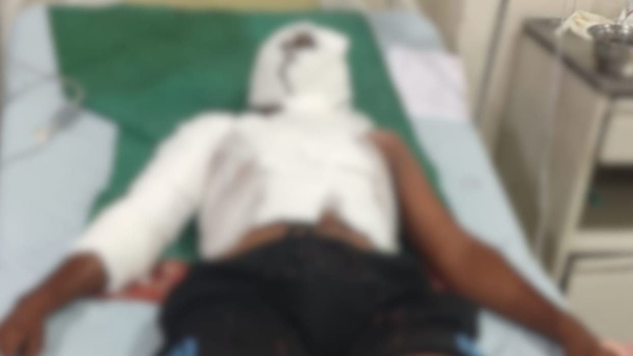 Varanasi student sleeping veranda suffers acid attack sustains severe burns complaint filed