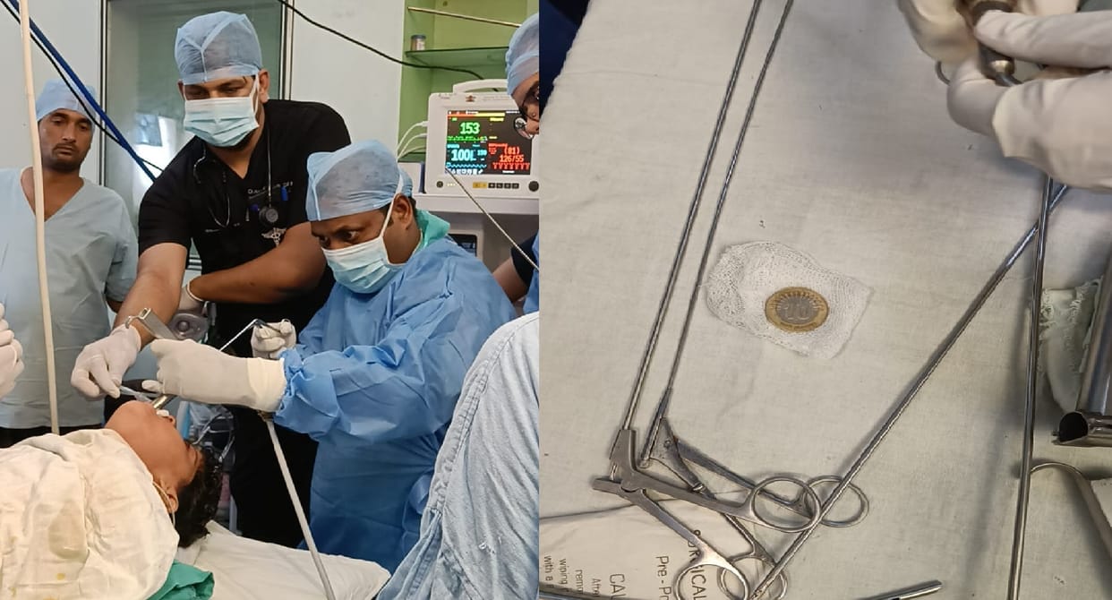 Kanpur 10 Rs coin stuck in throat ENT doctors removed it in a minute in hallet
