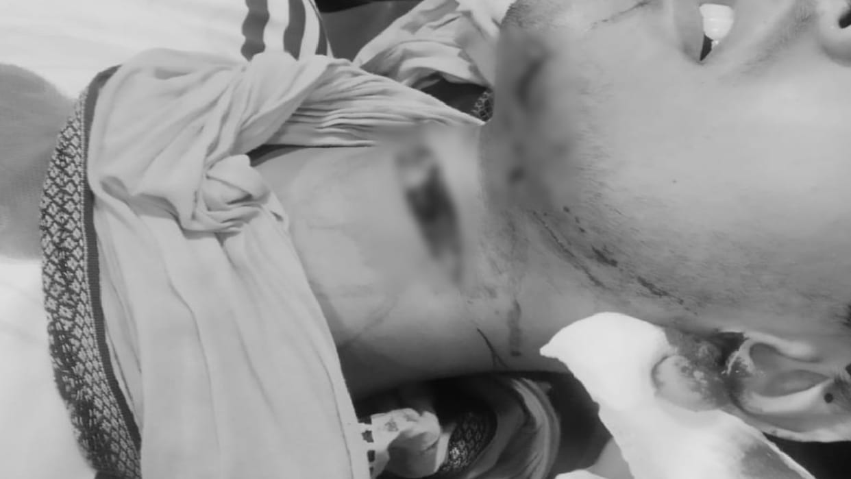 Student neck slashed by Chinese manjha bloodied and falls on flyover in Bareilly