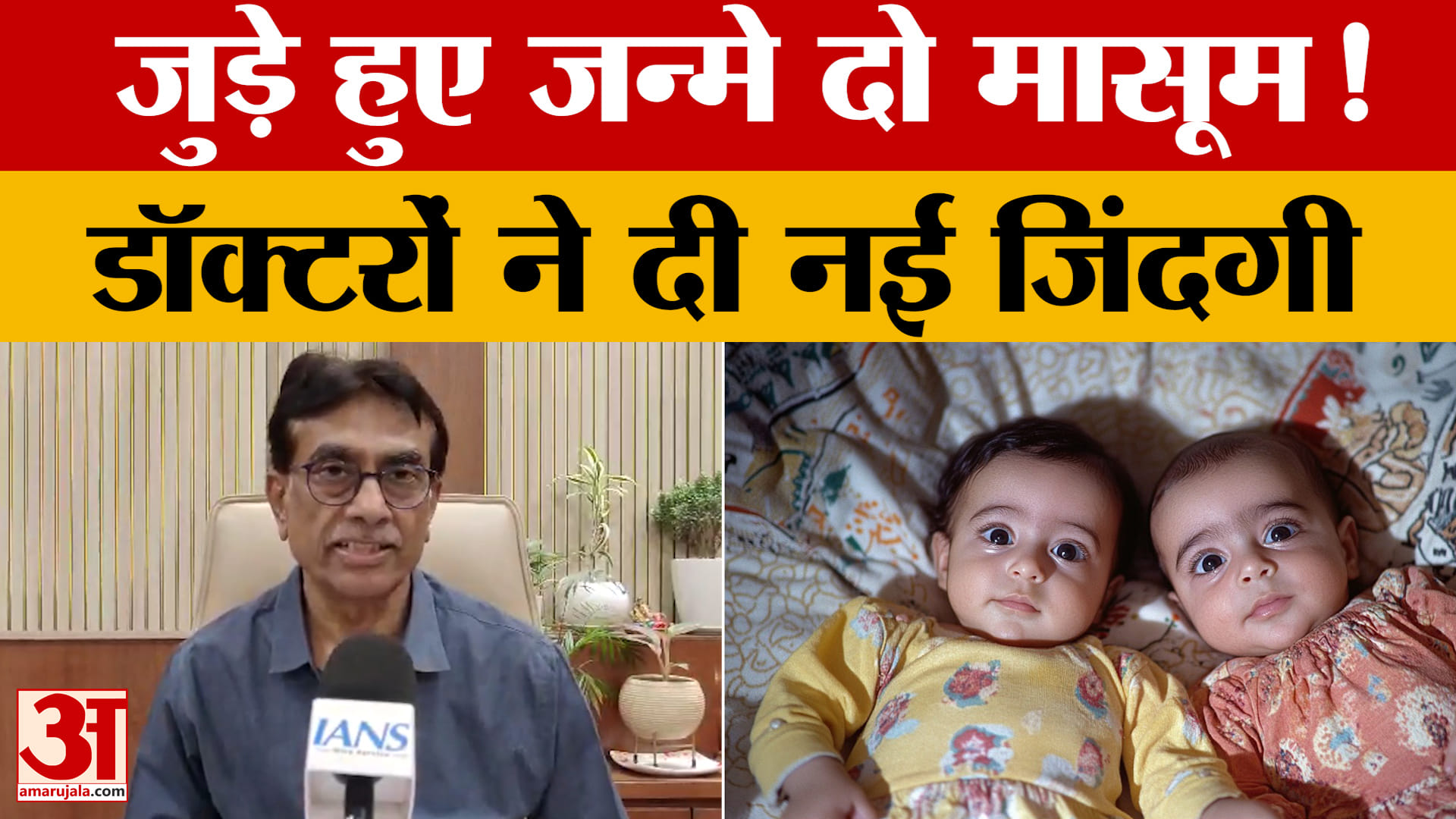 Madhya Pradesh: जन्म से जुड़े जुड़वां मासूमों को मिली नई जिंदगी, जटिल सर्जरी रही सफल