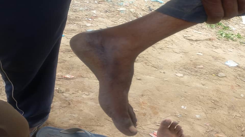 Garbage Yard: Firozabad Sanitation Workers Handle Waste Barefoot and Bare-Handed Suffer Fungal Infections