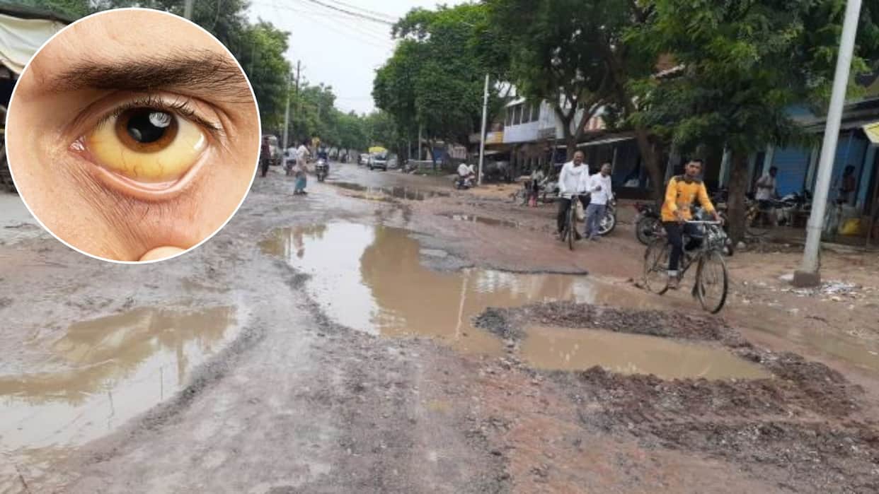 Dhamtari News: Risk of Waterborne Diseases Rises During Monsoon, Health Department Issues Alert and Precaution