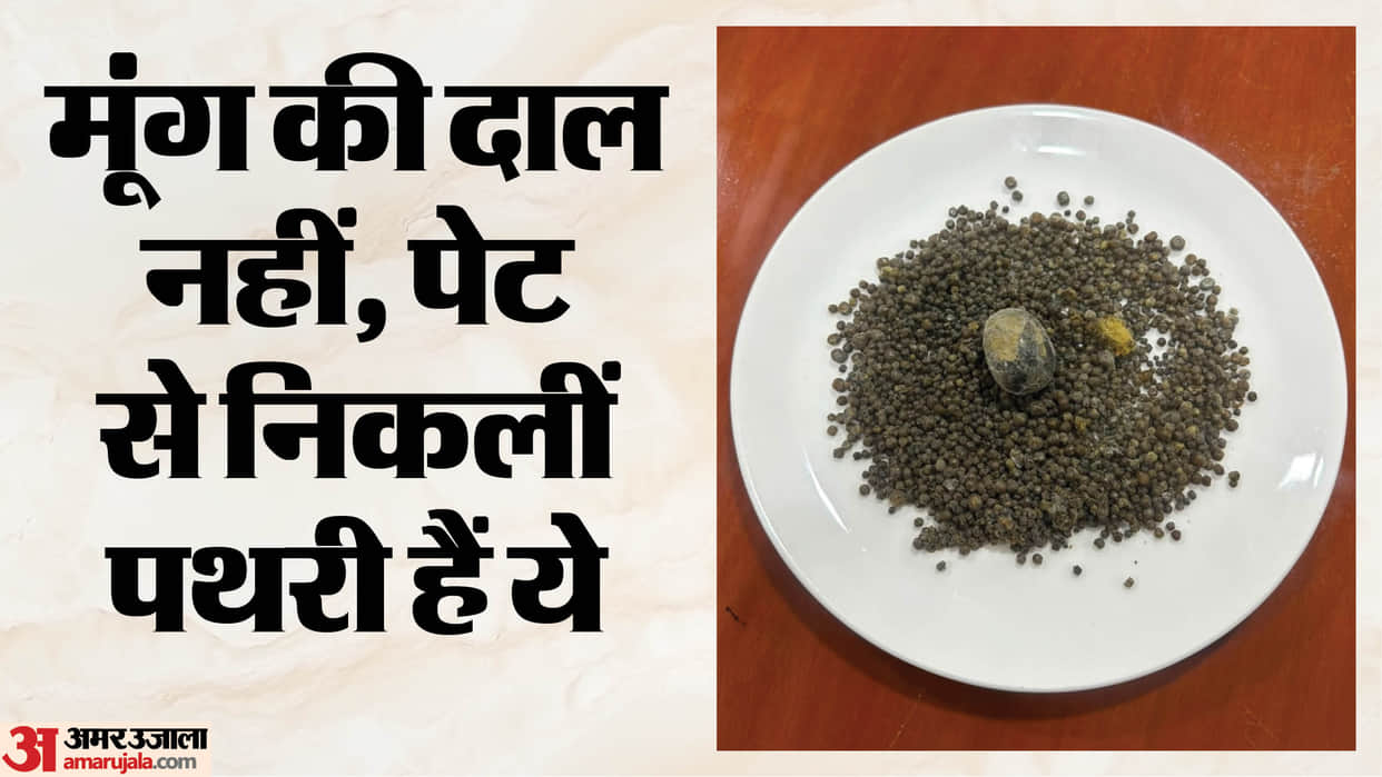 Doctors removed over 4000 stones from patient gallbladder during surgery