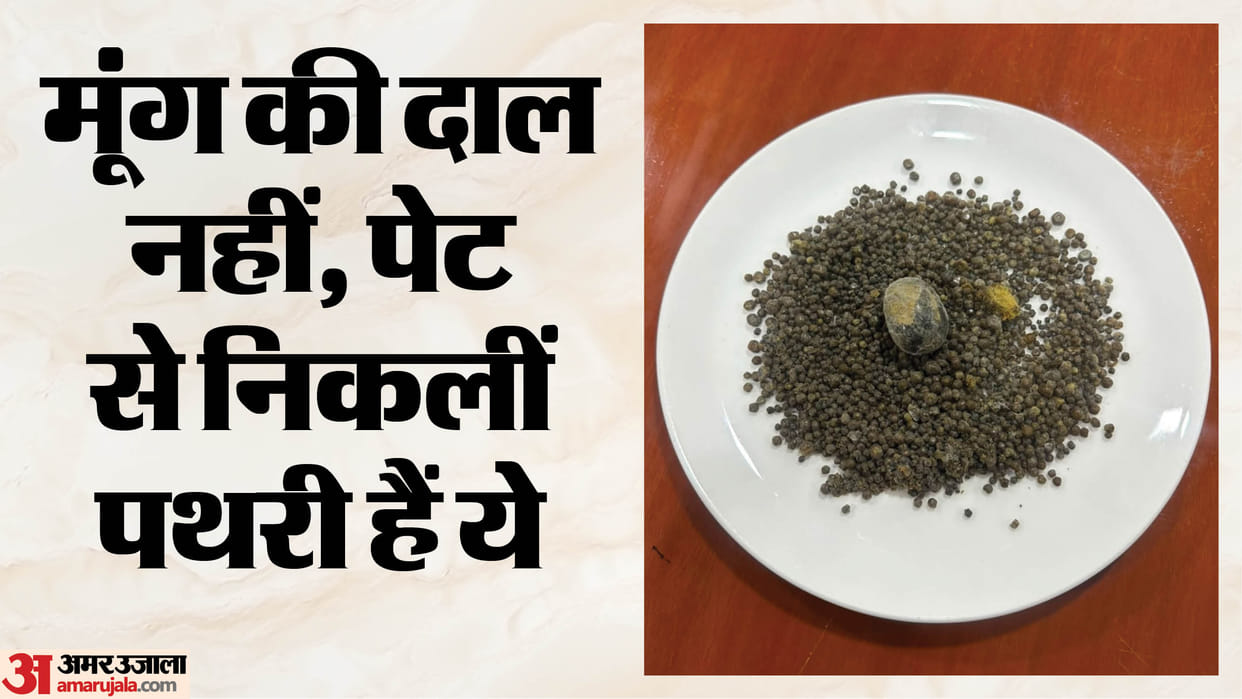 Doctors removed over 4000 stones from patient gallbladder during surgery