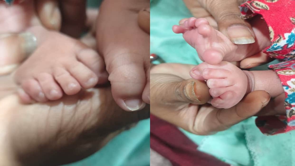 Himachal: Unique baby with 24 fingers born in Palampur; doctor explains the reason.