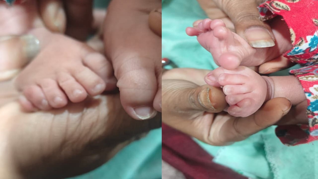 बच्चे के हाथों व पैरों में 6-6 उंगलियां।