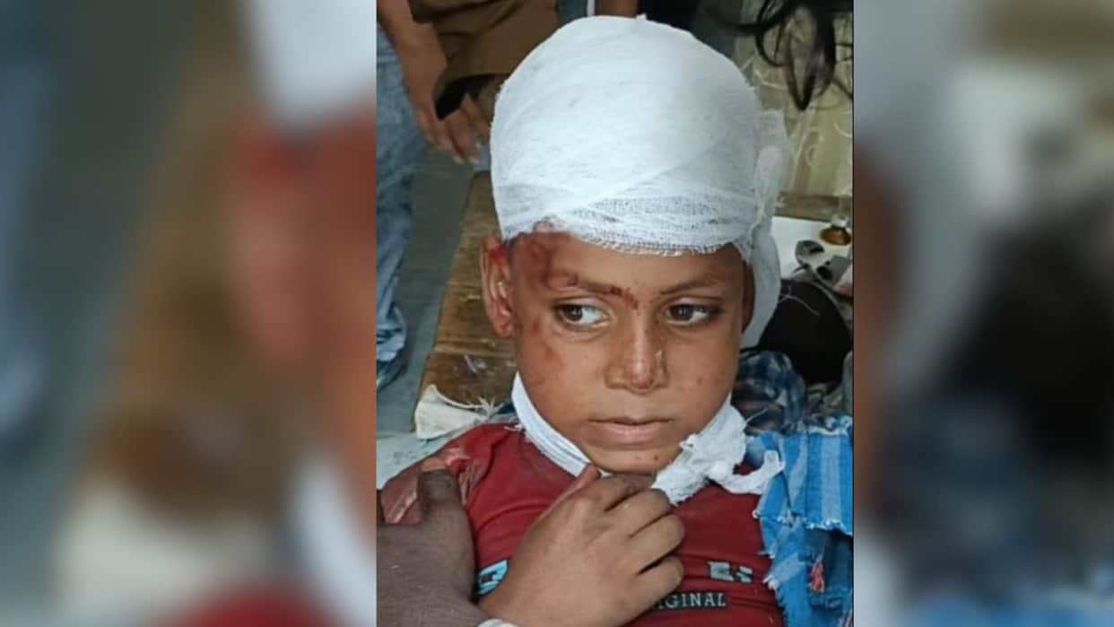 dogs attack on child deep wounds on head in jaunpur