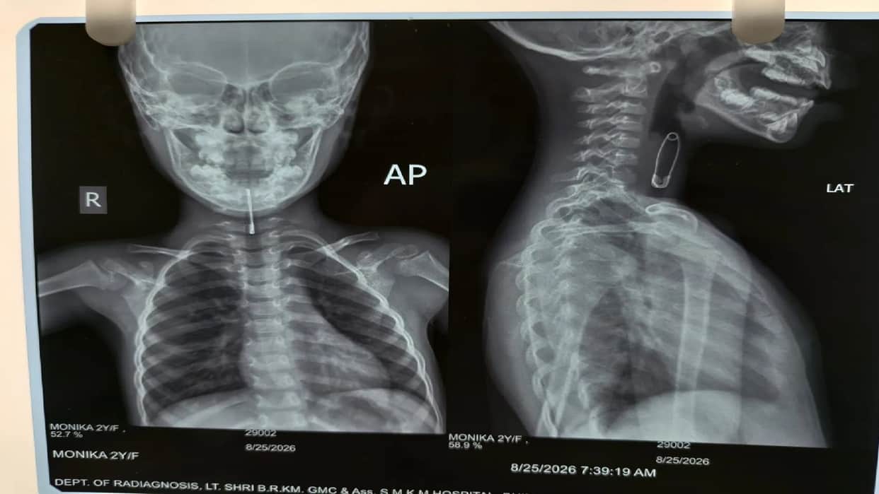 2-year-old child accidentally swallows safety pin while playing; successful surgery performed at MekaJ.