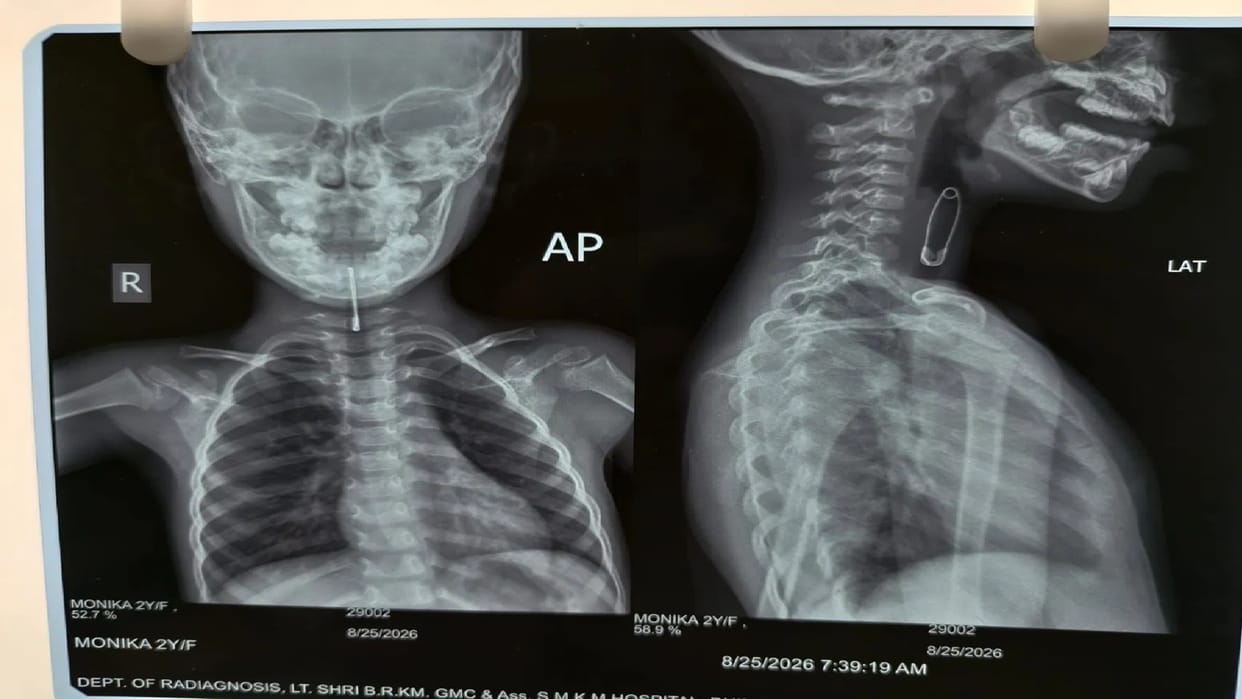 2-year-old child accidentally swallows safety pin while playing; successful surgery performed at MekaJ.