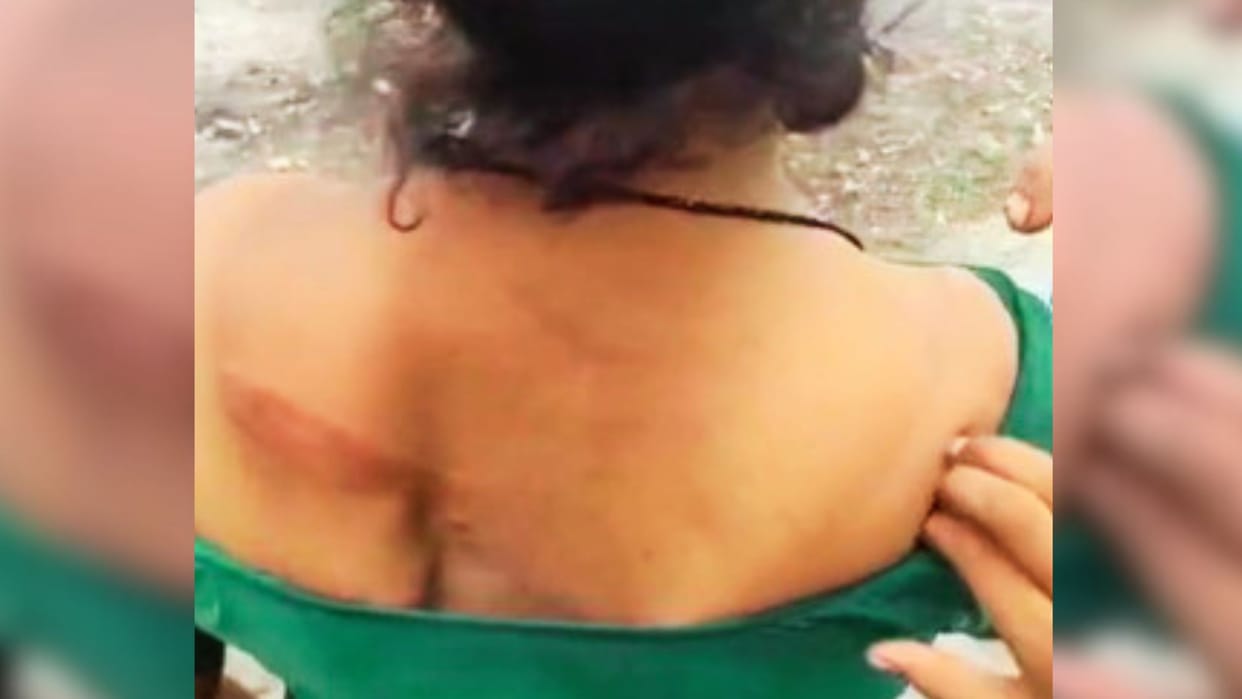 Controversy over halting meat sales Woman accuses town police in-charge of assault injury marks visible