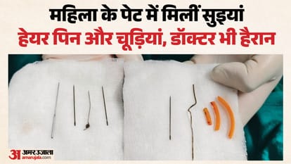 महिला के पेट से मिली सुइयां, हेयरपिन और चूड़ियां।