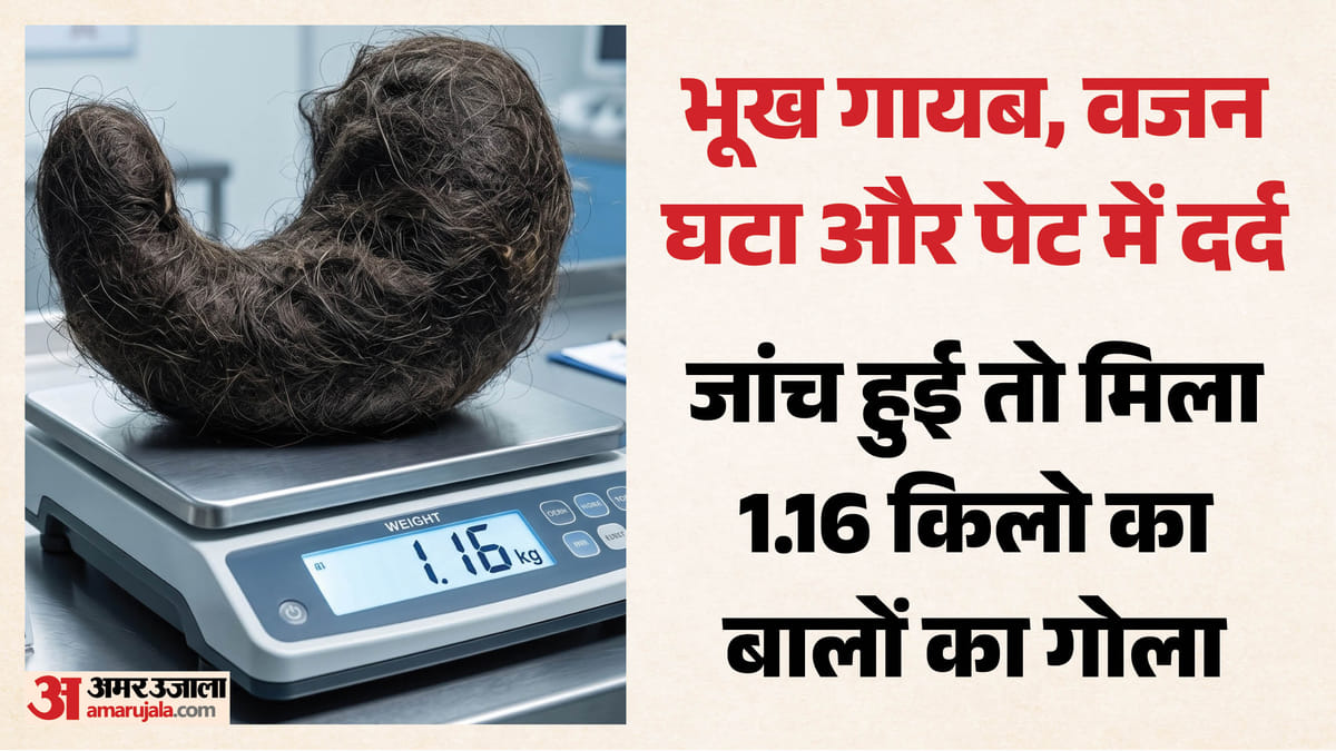 20 साल की लड़की ने 11 साल खाए बाल: पेट में बना 1.16 किलो का गोला, नहीं लगती थी भूख; गिरता गया वजन, ऐसे बची जान