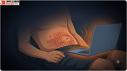 prolonged laptop use cause toasted skin syndrome by heat emitted from the device