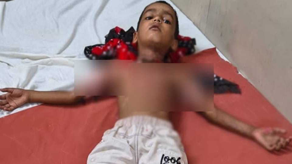teenager poured diesel on six-year-old boy and set him on fire while playing In Sitapur