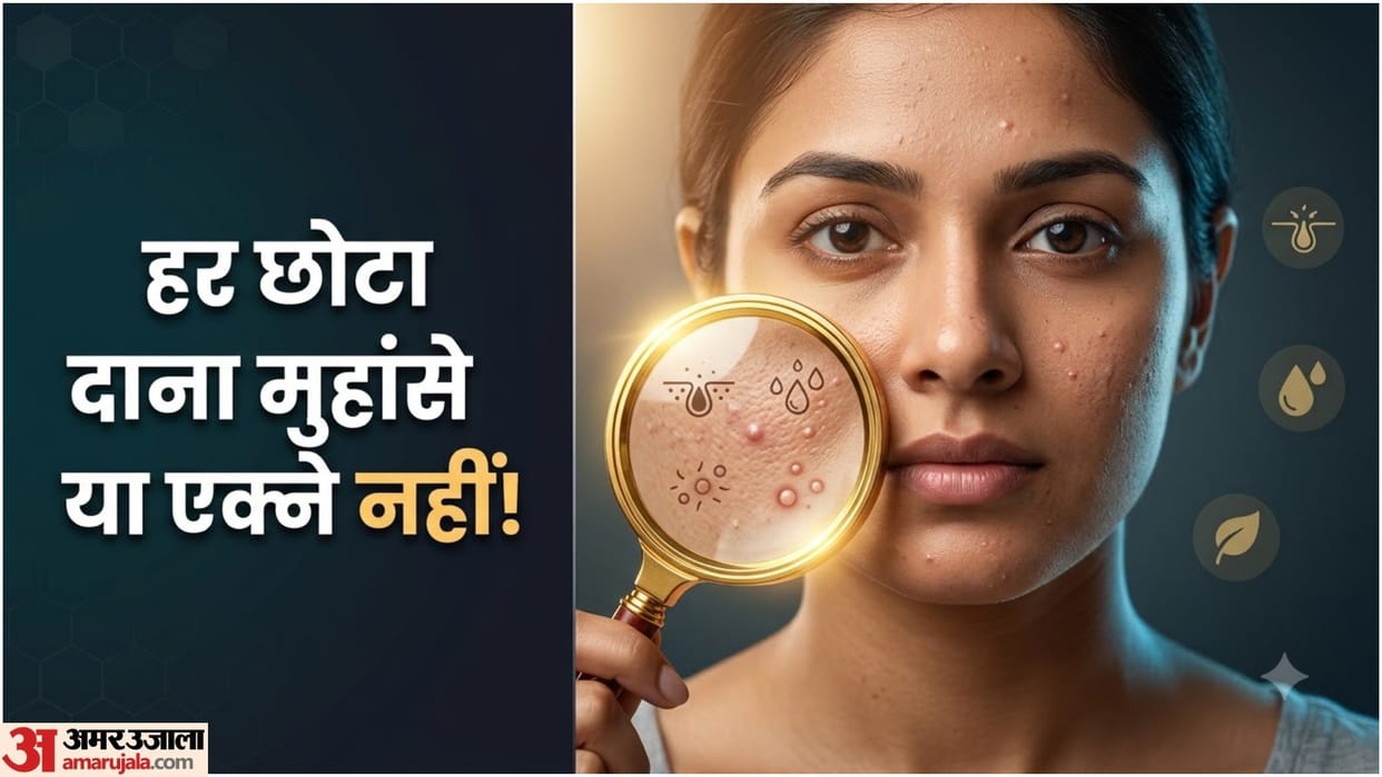 Acne, Pimples Or Tiny Bumps On Face Know Difference Causes And Skin Care Tips