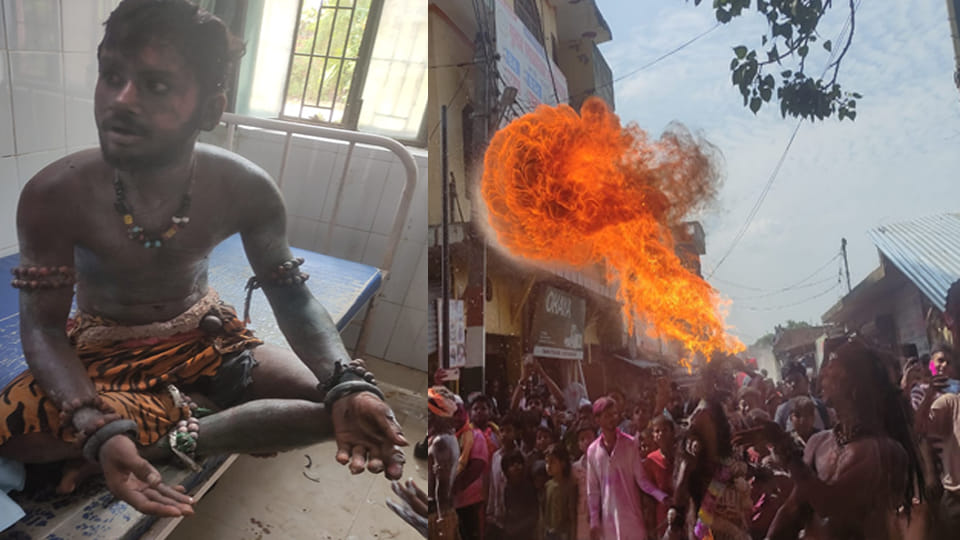 Hardoi: young man got burnt while performing the act of taking out fire from his mouth