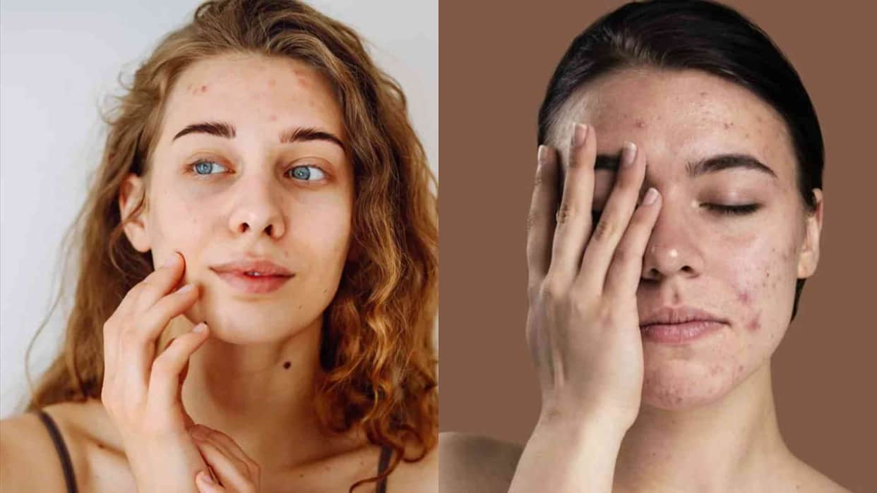 Glass Skin Trend Why Teens Should Avoid Overcomplicated Skincare Routines Experts offered advice