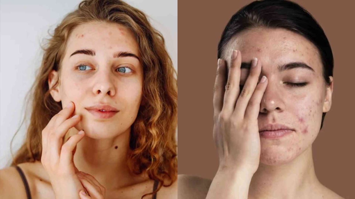 Glass Skin Trend Why Teens Should Avoid Overcomplicated Skincare Routines Experts offered advice
