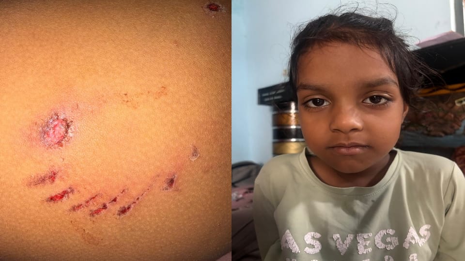 Meerut: A six-year-old girl playing outside her home was attacked by a dog; she has been admitted