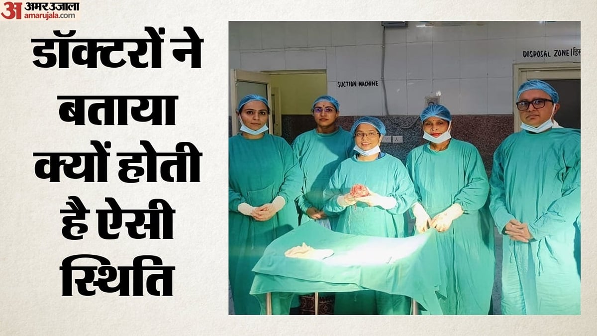 दुर्लभ: बिजनौर में गर्भ से निकाला चार माह का स्टोन बेबी, कैल्शियम जमने से पत्थर जैसा नजर आने लगा था भ्रूण
