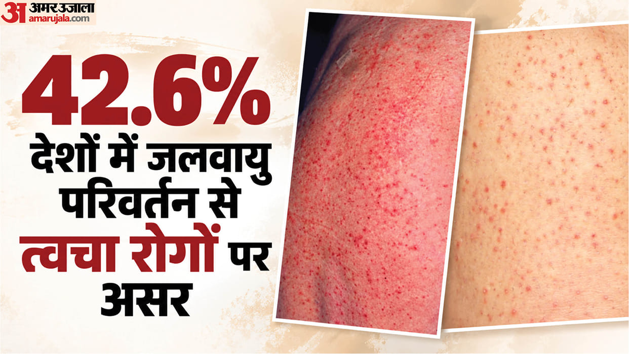 Changing weather challenge skin Growing infections inflammatory conditions; 42.6% countries report impact