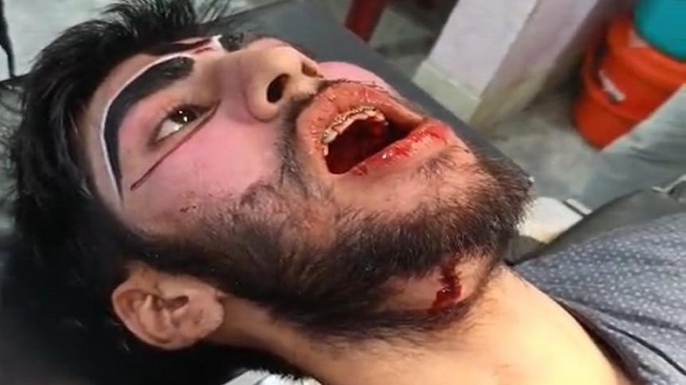 Artist injured by sword during Ramlila performance in khatima