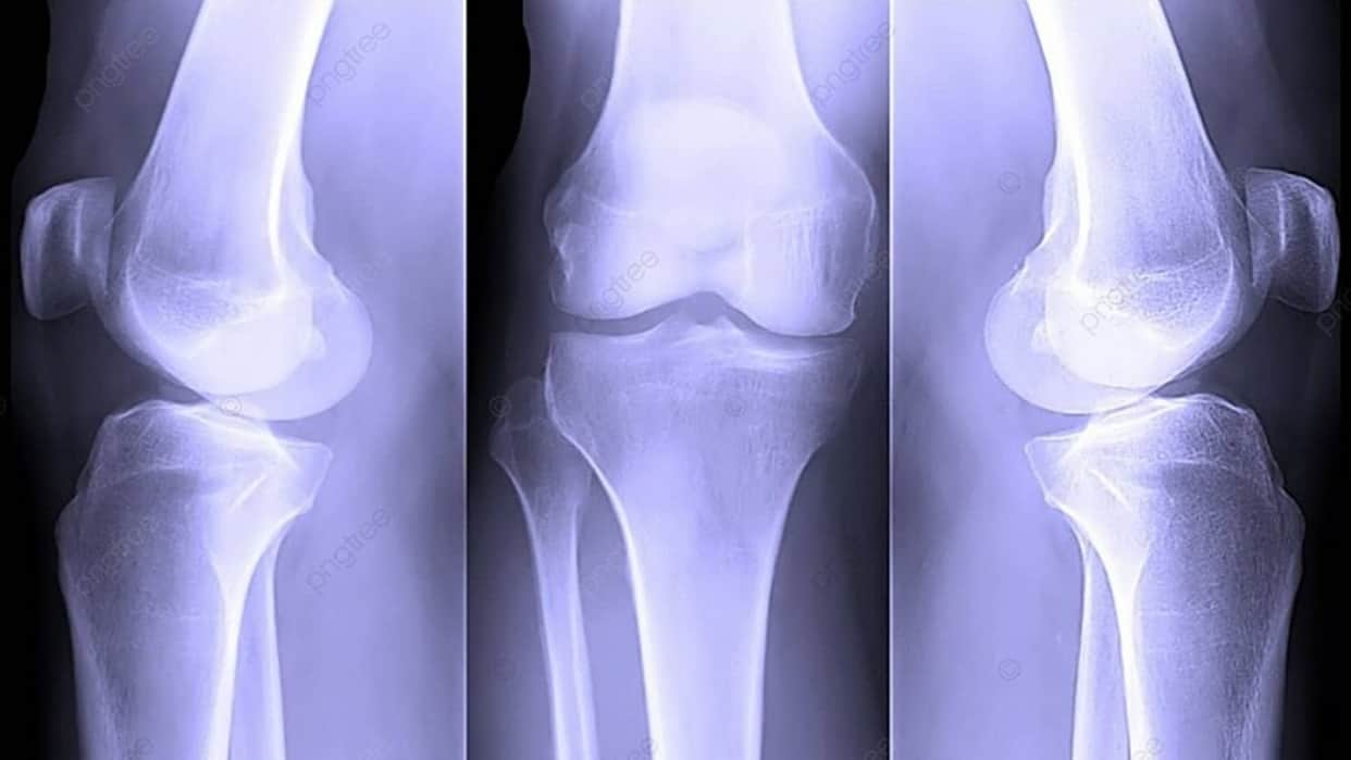 Raipur: AI Tool to Detect Bone Weakness From Routine X-Rays Shows 97.7% Accuracy in Early Testing